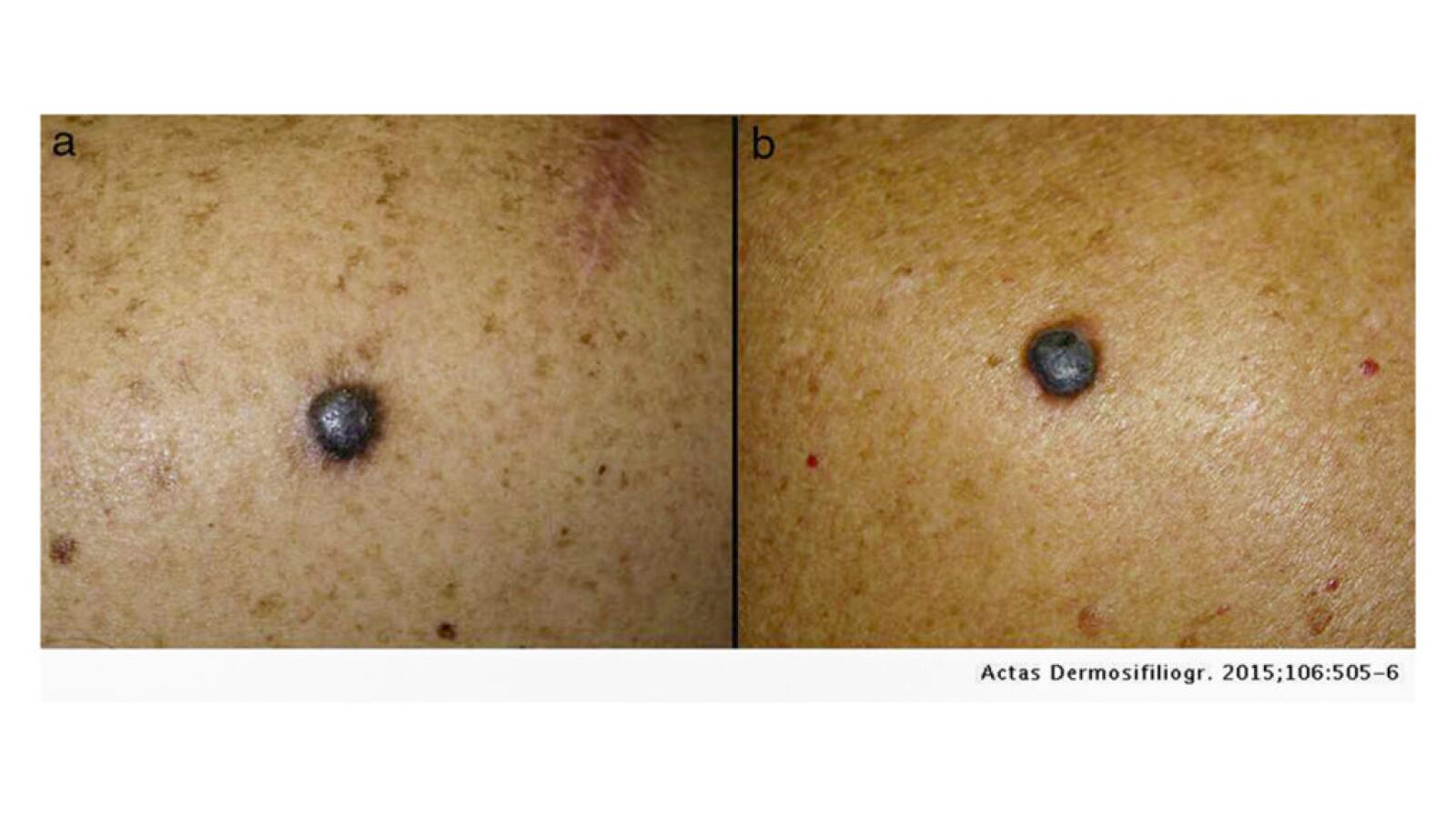 Nodular Melanoma Causes Symptoms And Treatments nodular-melanoma-causes-symptoms-and-treatments