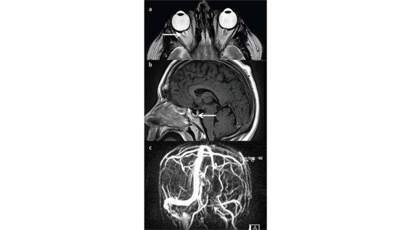 x ray for itracranial hypertension