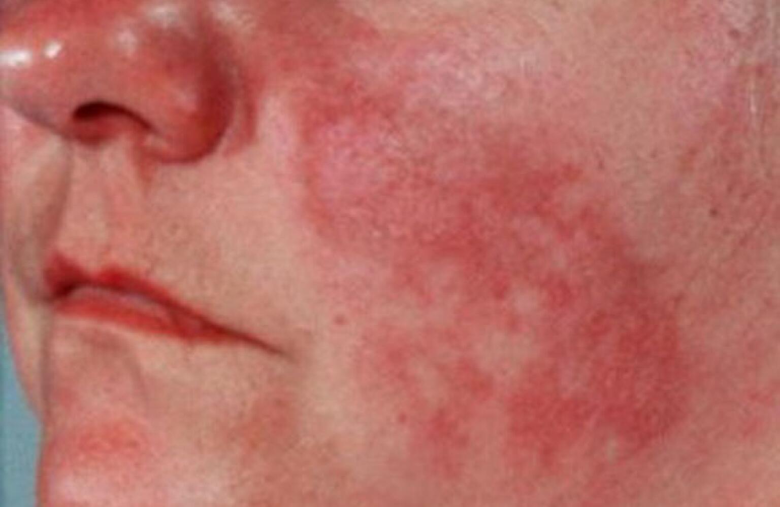 What Does a Lupus Rash Look Like?