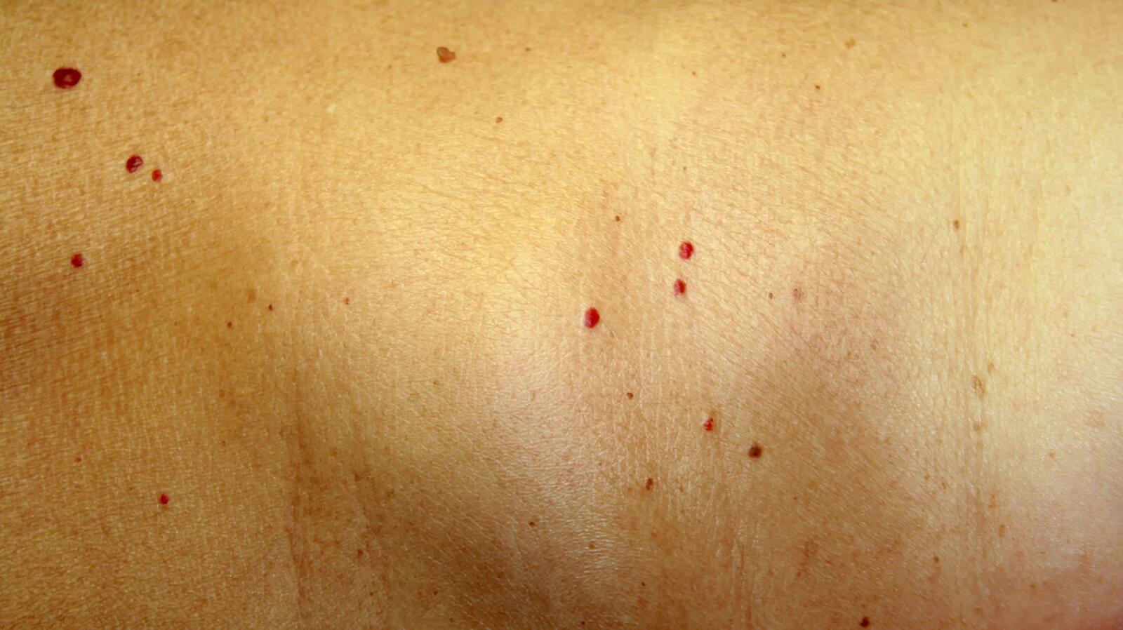 Cherry Angioma Symptoms Causes Treatment And Removal