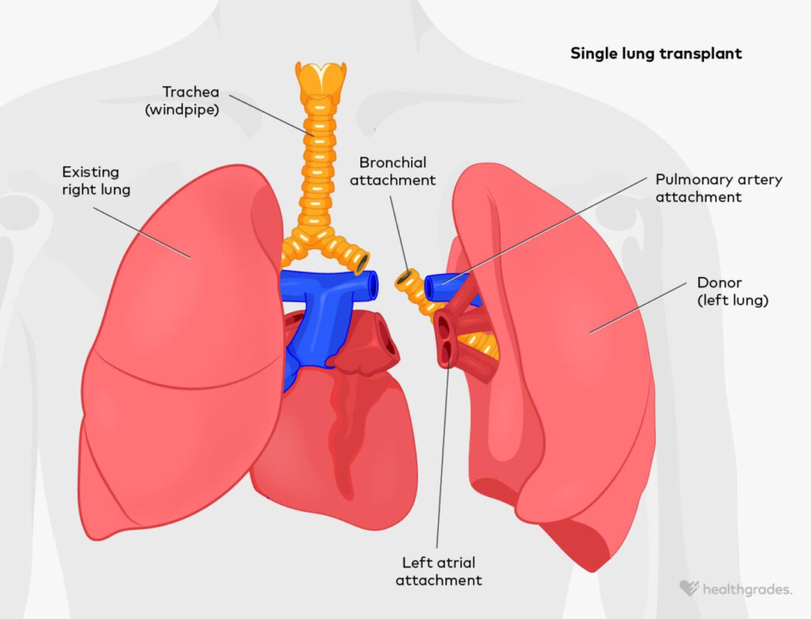 Lung Transplant: Surgical Details and What to Expect Lung Transplant: Surgical Details and What to Expect