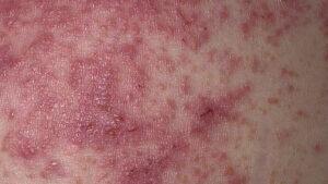 Spongiotic Dermatitis: Definition, Symptoms, Treatments