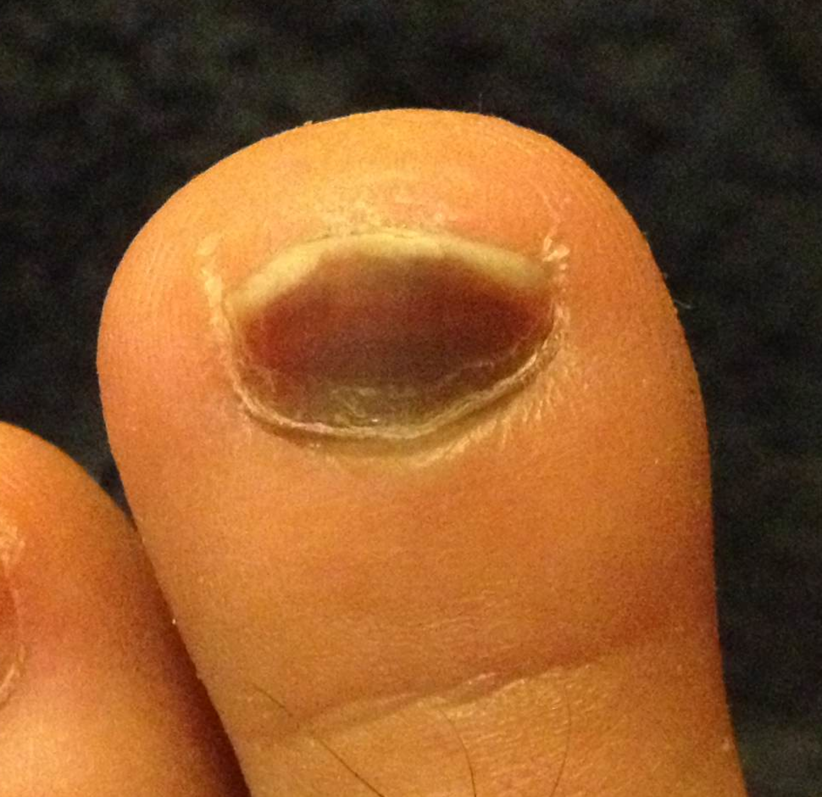 Toenail Discoloration Causes Related Symptoms Treatments 