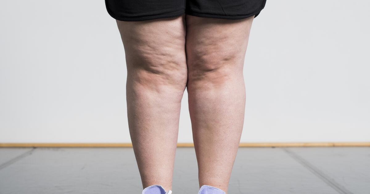 Understanding Hidradenitis Suppurativa Of The Groin