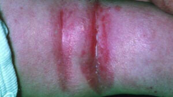 Flexor Rash Flexural Eczema: Causes, Symptoms, and Treatments