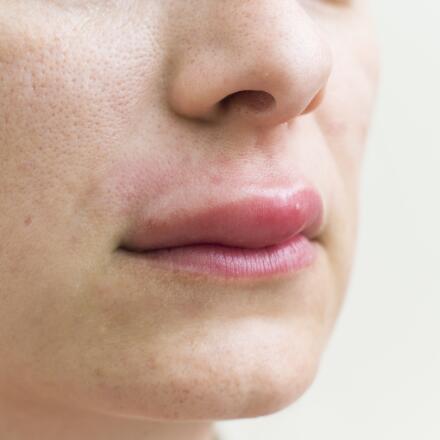 Angioedema is swelling under the skin, often due to an allergic reaction. Learn more about what causes angioedema, plus common symptoms and treatment options.
