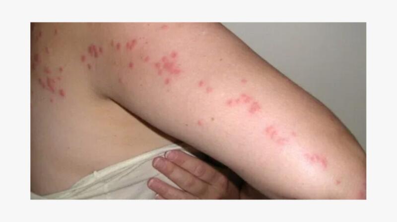 Bug Bite Pictures Symptoms Identification Treatment And More 