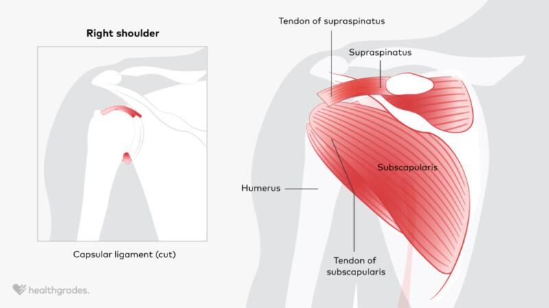 An Introduction to Rotator Cuff Tear