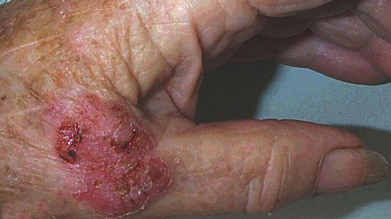 A bleeding and inflamed squamous cell carcinoma growth.