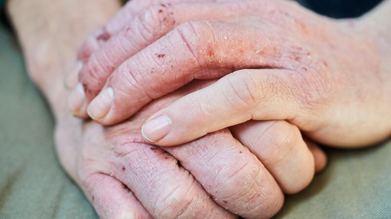 Hand Road Rash Rash on Hands: Symptoms, Treatments, Causes, and More